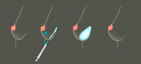 how hyaluronic is used for breast augmentation