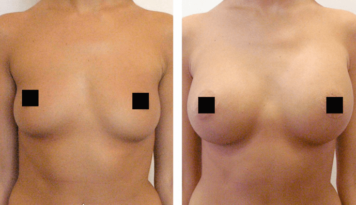 breast before and after enlargement with hyaluronic acid