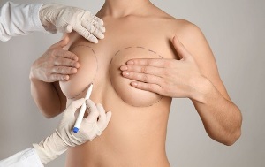 methods of surgical breast augmentation