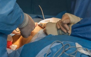 how to perform breast augmentation surgery