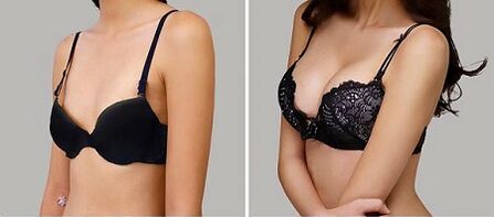 Photo before and after breast increases