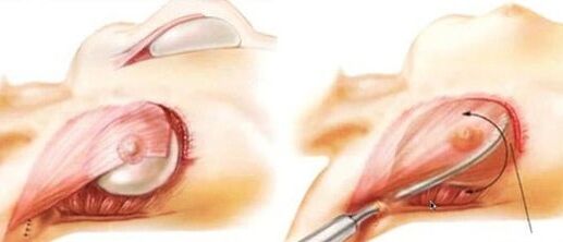 How is Breast Expanding Operation