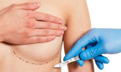 Submammaric access to busting with implants