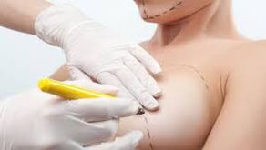 bust surgery