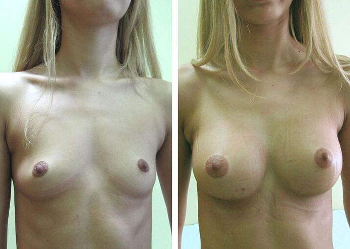 Before and after breast augmentation