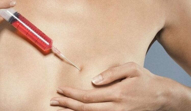 Breast augmentation with hyaluronic acid injection