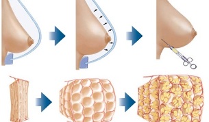 how to do breast augmentation with fat