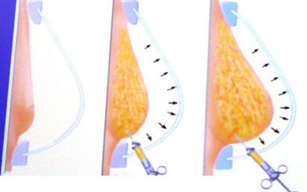breast augmentation with fat