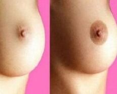 nipple enlargement before and after