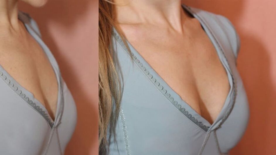 before and after breast enlargement products