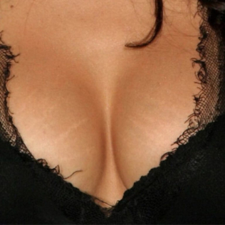 signs of breast augmentation